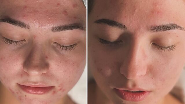 PIELBYANA-Skincare-before-and-after